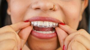 Woman putting on her Invisalign tray